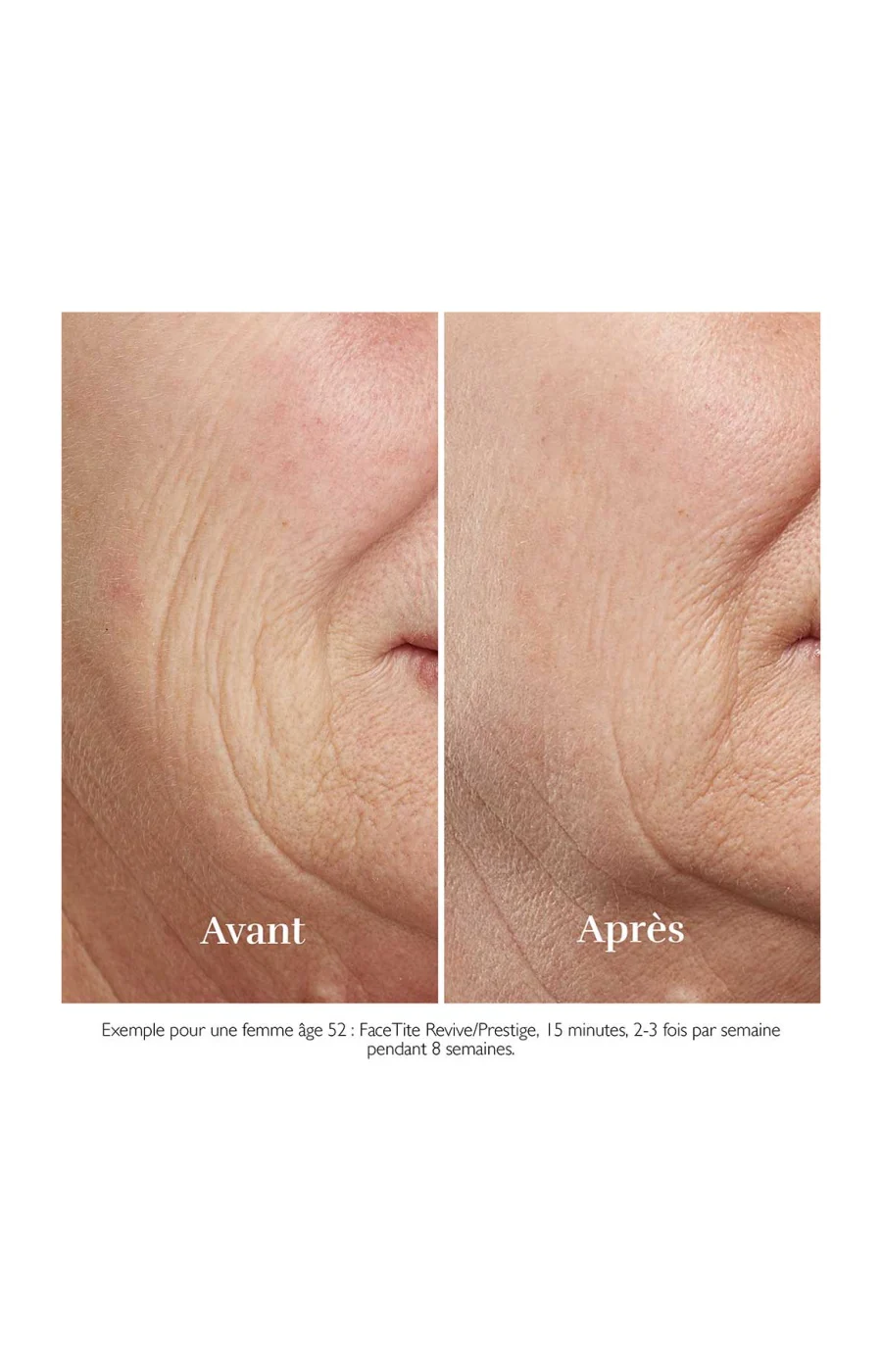Appareil anti-âge - FaceTite Revive - Visage - Image 5